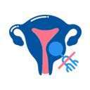 ল্যাপারোস্কোপিক মায়োমেকটমি